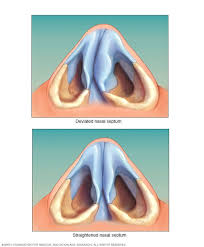 Deviated Septum Symptoms And Causes Mayo Clinic Nasal Septum Nose Surgery Rhinoplasty