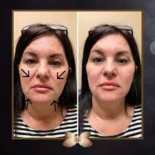 This surgery pulls the sagging skin on the cheeks upward, lessening smile lines. How To Get Rid Of Nasolabial Folds Arxiusarquitectura