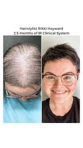 Lack of which hormone most likely causes women's hair to thin?