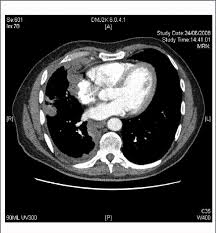 Nickell lt jr et al: Computed Tomography Ct Showing Advancedstage Pleural Mesothelioma Download Scientific Diagram