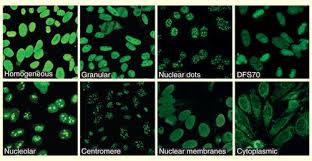 Image result for ANA Staining Pattern