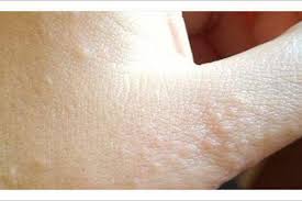 Maybe you would like to learn more about one of these? Dishidrosis Granitos En Las Farmacia Ortopedia Arango Facebook