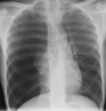 Bilateral simultaneous thoracotomy for unilateral spontaneous pneumothorax, with spetial referens to the. How Should Complete Lung Collapse Secondary To Primary Spontaneous Pneumothorax Be Managed Rcp Journals
