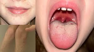 Image result for Strep throat infection roof of mouth
