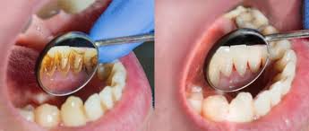 Wenn sie eine buche zurückschneiden möchten, ist die beste zeit dafür das frühjahr. Professionelle Zahnreinigung Sinnvoll Testsiegertarife De