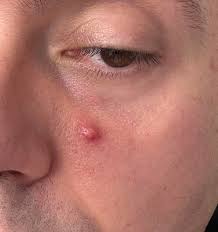 Image result for Pustule