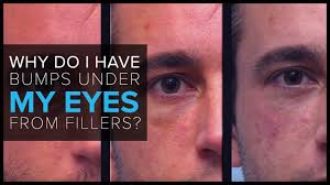 You can probably answer it yourself! Faq Why Do I Have Bumps Under My Eyes After Receiving Fillers Youtube