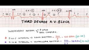This is known as an escape rhythm. Third Degree Heart Block Complete A V Block Ecg Interpretation Of Complete Heart Block Youtube