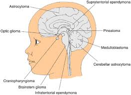 The tumor will make the body feel weak and tired, even when you should be full of energy from good sleeping time. Oncology Brain Tumors Children S Wisconsin