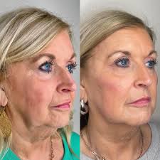 SO EXCITED to announce that we now have @glo2facial at MAC 💗 @sknbyerin  will be showing you all this at our ONE YEAR OPEN HOUSE Be sure to check  out the specials