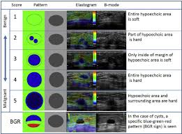 The controversy surrounds what constitutes a clear margin. Elasticity Score In Breast Cancer Diagnosis The Elasticity Score Is A Download Scientific Diagram