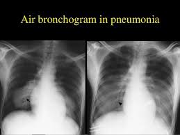 Image result for Air Bronchogram