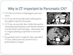 Pancreatic duct dilatation and cutoff are early findings associated with the development of pancrea … Staging Pancreatic Carcinoma And Liver Carcinoma Using Ct Scan Ppt Video Online Download