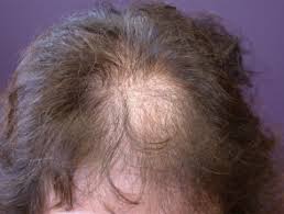 It can cause period problems, reduced fertility, excess hair growth, and acne. Polycystic Ovary Syndrome Dermnet Nz