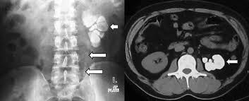 Image result for Genitourinary Tuberculosis