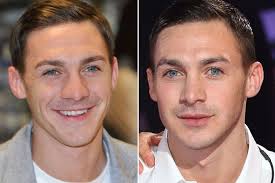 Male rhinoplasty before and after. Rebecca Adlington And Nine Other Celebrity Nose Jobs Mirror Online