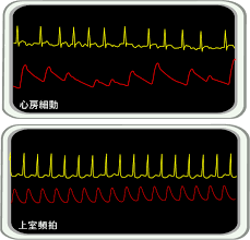 Oct 29, 2020 · psvtの基礎知識と心電図波形、原因、治療、看護のポイントをまとめました。psvtは循環器内科や救急外来ではよく遭遇する不整脈です。ただ、それ以外の診療科でも患者が発作を起こすことはあります。 å¿ƒæˆ¿ç´°å‹•ã¨ä¸Šå®¤é »æ‹ã«ãŠã'ã‚‹è¡€åœ§æ³¢å½¢ã®é•ã„