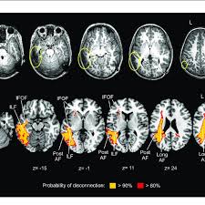 Image result for Brain Lesion