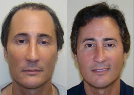 Natural Hair Transplant Clinic in Texas Hidalgo Cuellar Colonia Number 2