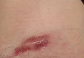 The treatment of ingrown hair cyst. Hidradenitis Suppurativa Stage 1 Hs Stages Hidrawear