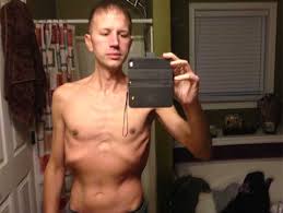 Image result for Polymyositis