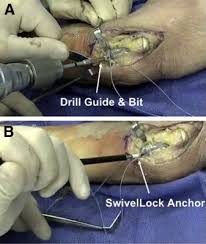A ucl is a ligament on the inner side of your elbow that helps secure your elbow joint. Ulnar Collateral Ligament Reconstruction Technique Utilizing Suture Tape Augmentation Sciencedirect