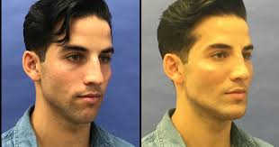 As Stigma Lifts More Men Opt For Plastic Surgery From Torso Tucks To Botox Plastic Surgery Hair Transplant Surgery Botox