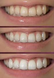 Para Obtener Un 20 De Descuento Contactame Por Privado Brillo Y Blanquea Los Dient Pasta De Dientes Blanqueadora Pasta Dental Blanqueadora Pasta Dental