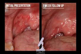 Image result for Aphthasol