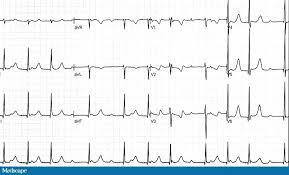 Ekg Quiz Welche Art Von Av Block Liegt Vor