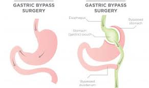 Does united healthcare insurance cover lap band surgery. United Healthcare Bariatric Surgery Requirements Bariatric Journal