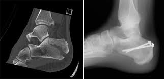Image result for what is the treatment for a fractured heel