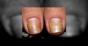 Ca Urmare A Umiditatii Mucegaiului Si Bacteriilor Infectiile Fungice Pot Aparea La Picioare Si La Unghii De Cele Mai Multe Ori Fiin Nails Gold Rings Beauty