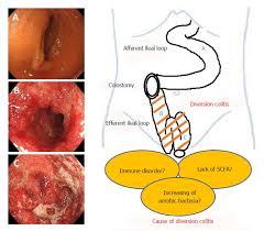 Indeed, the histologic features of this entity were. Diversion Colitis And Pouchitis A Mini Review