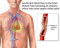 Image result for Chest Pain