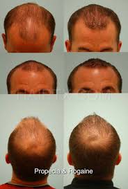 Rogaine (minoxidil) can cause noticeable hair loss when first started, and generally persists for up to 2 weeks. Rogaine Minoxidil Dallas Hair Regrowth Treatment Plano Tx
