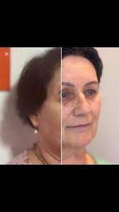 4 meses de pós desse tratamento rejuvenescedor que só melhora. Esse é o  diferencial da estética regenerativa: não é quanto tempo vai durar, é  quanto ainda vai melhorar!!! , Segura!! 🚀🚀🚀, ...