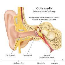 Mittelohrentzundung Otitis Media Verlauf Symptome Behandlung