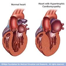 Hypertrophic Cardiomyopathy Hypertrophic Cardiomyopathy Dilated Cardiomyopathy Heart Care