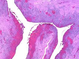 Medications can be prescribed to help control pain and. Webpathology Com A Collection Of Surgical Pathology Images