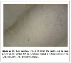 While an infected ingrown hair cyst starts off as a regular ingrown hair, acne cysts are caused by a combination of bacteria, oil, and dead skin cells that accumulate deep under the hair follicle. Two New Signs Halo Sign And Wipeout Sign To Differentiate Black Dots From Hair Dust On Trichoscopy