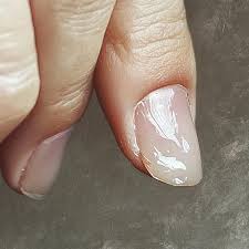 Image result for Koilonychia feet