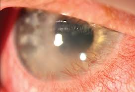 Herpes simplex virus (hsv) is a very common, lifelong infection that often is asymptomatic. A Primer On Herpes Simplex Keratitis Modern Optometry