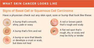 Melanoma is the most dangerous t. How To Detect Skin Cancer Roswell Park Comprehensive Cancer Center