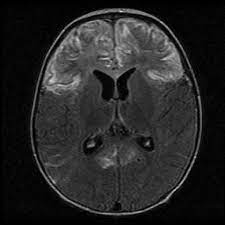 Herpes simplex virus (hsv) encephalitis hsv encephalitis (hsve) is the most common cause of infectious encephalitis (1); Choreoathetosis After Herpes Simplex Encephalitis With Basal Ganglia Involvement On Mri American Academy Of Pediatrics