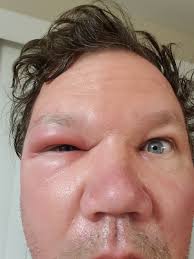 File:Bee Sting 20200810 054544.jpg