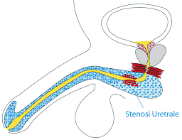 A study of 374 cases. Stenosi Uretrale Sintomi Cause E Cura Dott Enzo Palminteri