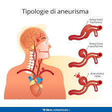 Artärbråck c, pulsåderbråck c, aneurysm c. Aneurisma Sintomi Significato E Prevenzione