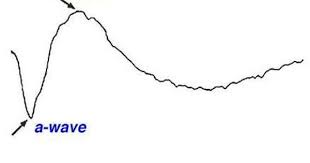 Electroretinogram Erg 1 A Wave Initial Corneal Negative Deflection Derived From The Cones And Rods Of The Outer Photor The Retina Multifocal Clinic