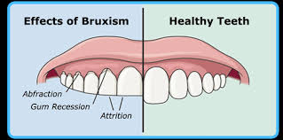 Deep clean your mouth guard once a week. Teeth Night Guard Bruxism Dental Mouth Guard Gum Sleeping Teeth Grinding Sporting Goods Mouth Guards Romeinformation It